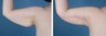 Arm Lift (Brachioplasty)