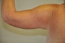 arm lift
