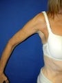 Extended Brachioplasty Bilaterally