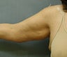 Brachioplasty