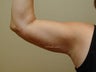 Brachioplasty