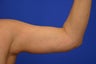 Arm lift