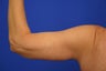 Arm lift