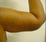 BRACHIOPLASTY (ARM LIFT)