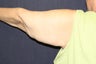 Arm Lift (Brachioplasty)