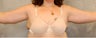Brachioplasty