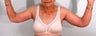 Brachioplasty