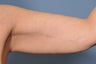 Arm Lift