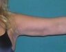 Arm Lift
