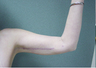 Brachioplasty