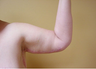Brachioplasty