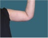 Arm lift
