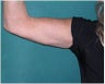 Arm lift