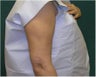 Liposuction of the arms