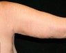 Arm Lift