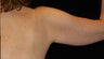Arm Lift