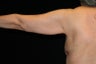 Arm Lift