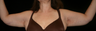 Brachioplasty