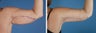 Arm Lift (Brachioplasty)