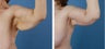 Arm lift (Brachioplasty)