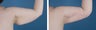 Arm Lift (Brachioplasty)
