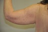 arm lift