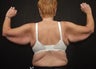 Brachioplasty (Arm Lift)