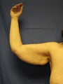 Arm Lift