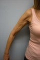 Extended Brachioplasty Bilaterally