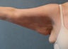 Brachioplasty
