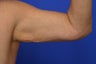 Arm lift