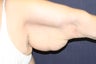 Brachioplasty (Arm Lift)