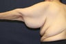 Arm Lift (Brachioplasty)