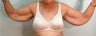 Brachioplasty