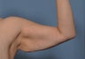 Arm Lift