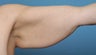 Arm Lift