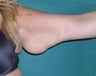 Arm Lift