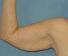 Brachioplasty