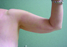 Brachioplasty