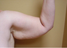Brachioplasty