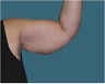 Arm lift