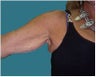 Arm lift
