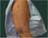 Liposuction of the arms