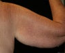 Arm Lift
