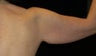 Arm Lift