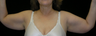 Brachioplasty