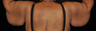 Brachioplasty