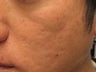 Artefill treatment of Acne Scars