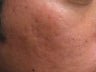 Artefill treatment of Acne Scars