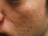 Artefill treatment of Acne Scars